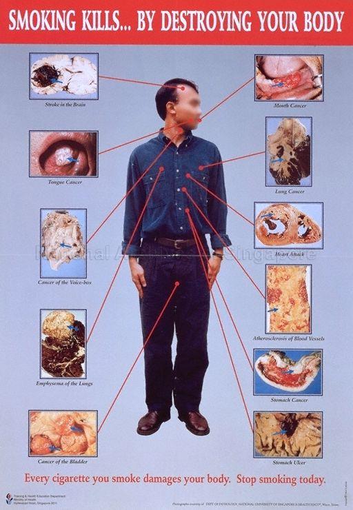 Smoking Kills… By Destroying Your Body * Every Cigarette You Smoke Damages Your Body. Stop Smoking Today.